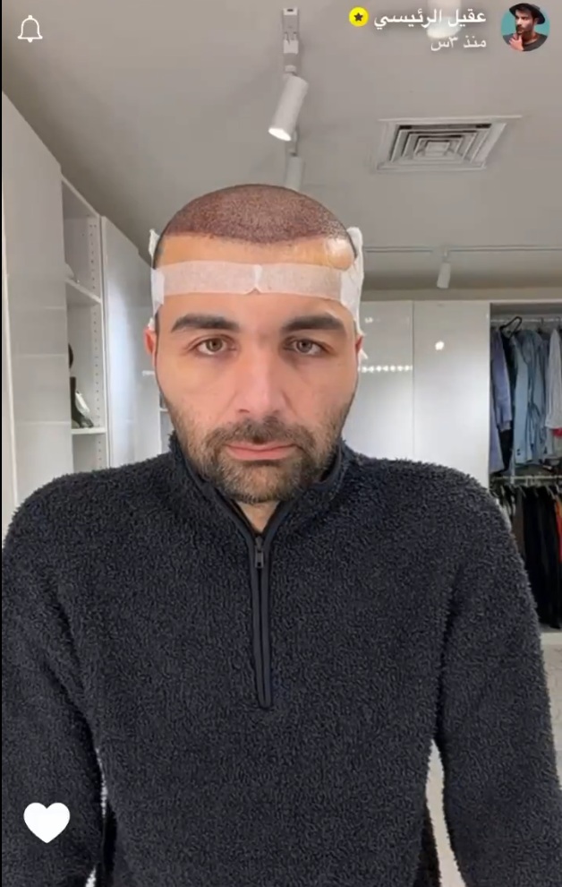 عقيل الرئيسي - زراعة الشعر - انتفاخ الوجه بعد زراعة الشعر - عقيل الرئيسي يطمئن جمهوره - تفاصيل زراعة الشعر