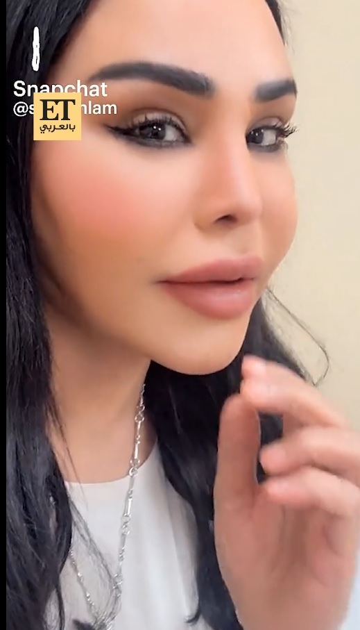 أحلام الشمسي - عملية تجميل أنف - نتائج قبل وبعد - تعديل فتحات الأنف - تحسين الصوت بعد العملية - تجميل في دبي