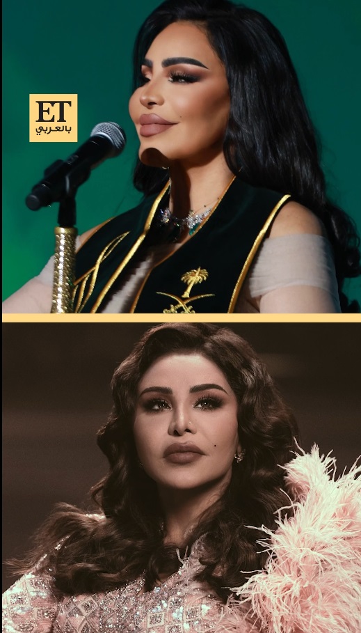 أحلام الشمسي - عملية تجميل أنف - نتائج قبل وبعد - تعديل فتحات الأنف - تحسين الصوت بعد العملية - تجميل في دبي