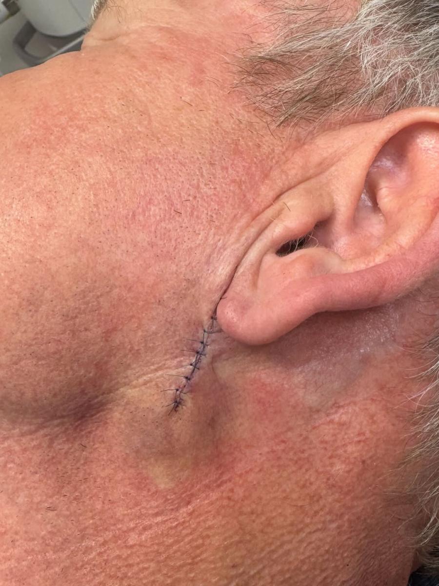 غوردون رامزي Gordon Ramsay - إنستغرام Instagram - سرطان الجلد Basal Cell Carcinoma - The Skin Associates - Mayo Clinic - مستشفى Lawerence + Memorial Hospital - نيو لندن New London - كونيتيكت Connecticut - برنامج MasterChef - أخبار هوليوود - مشاهير هوليوود