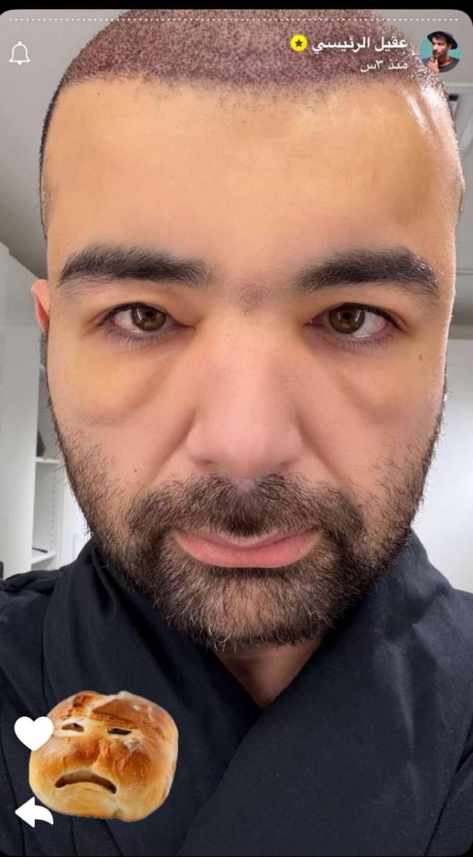 عقيل الرئيسي - زراعة الشعر - انتفاخ الوجه بعد زراعة الشعر - عقيل الرئيسي يطمئن جمهوره - تفاصيل زراعة الشعر