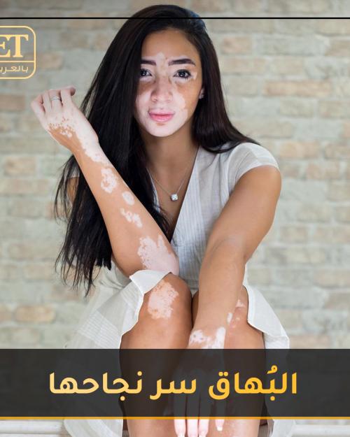 البُهاق سر نجاح