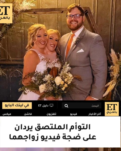 التوأم الملتصق