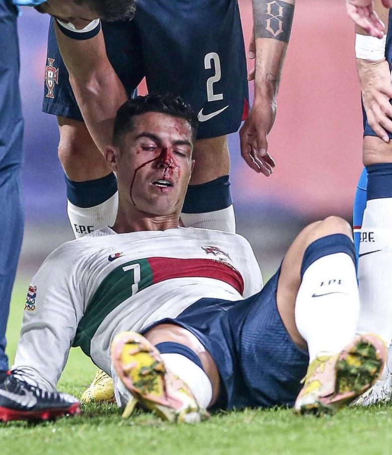 إصابة كريستيانو رونالدو في مباراة البرتغال و التشيك 