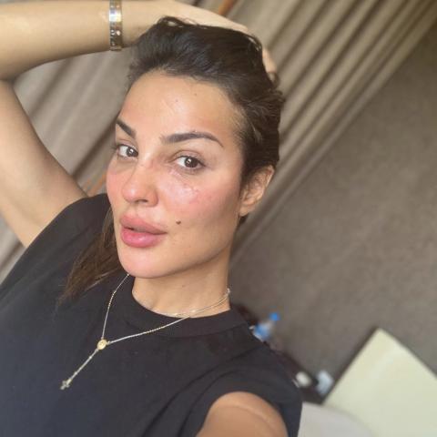 نادين نسيب نجيم تكشف عن الجروح في وجهها